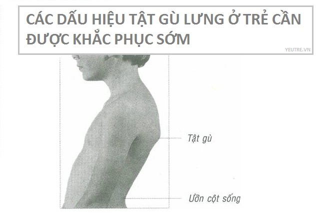 tật gù lưng