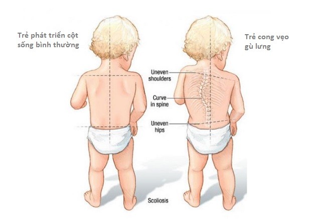 bệnh gù lưng ở trẻ nhỏ