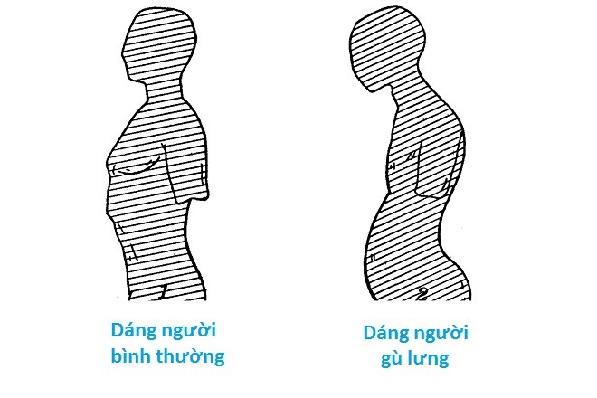 dấu hiệu gù lưng