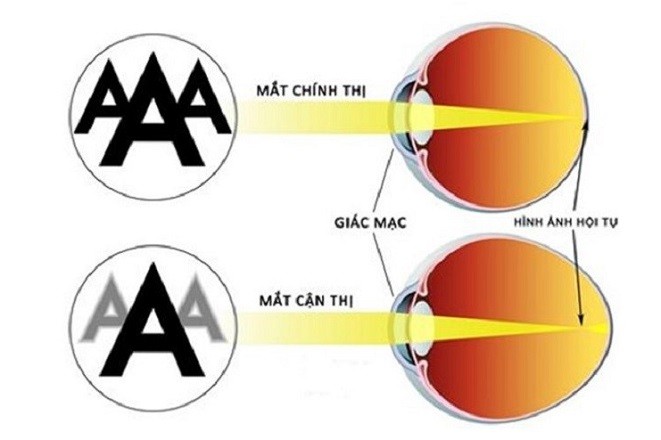 mô phỏng cơ chế hoạt động mắt thường và mắt cận thị