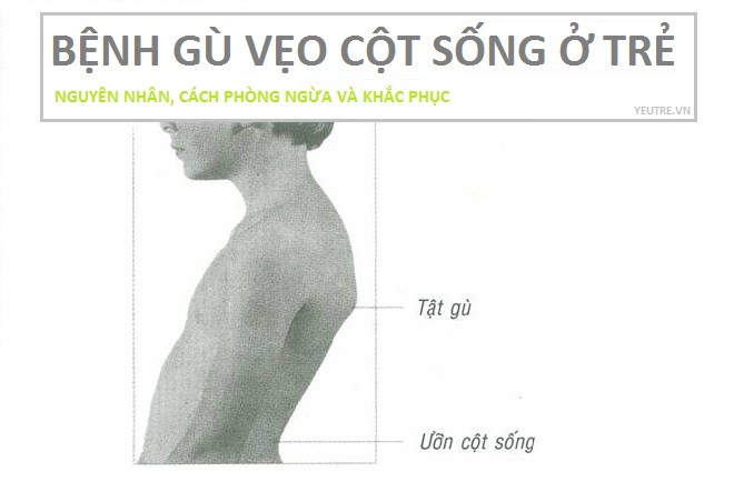 bệnh gù vẹo cột sống