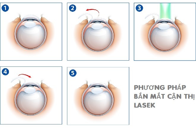 bắn mắt cận thị lasek