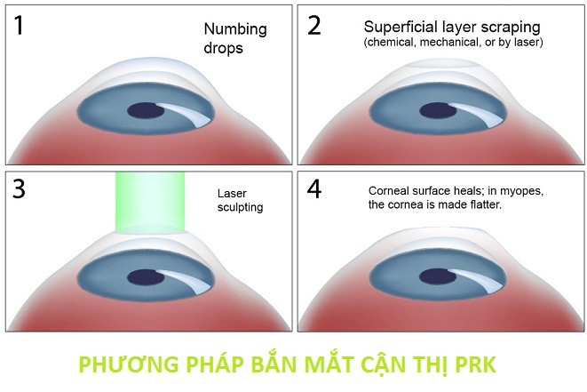 bắn mắt cận thị prk