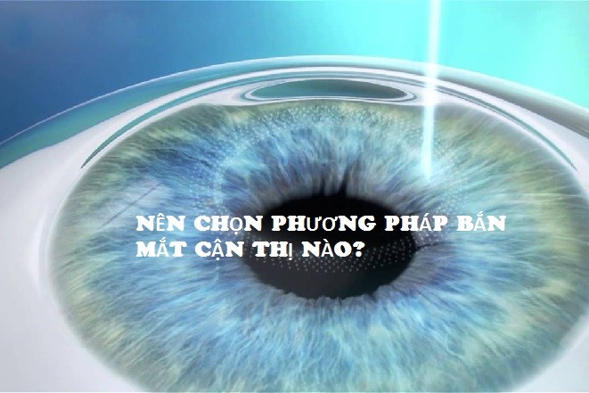 phương pháp bắn mắt cận thị
