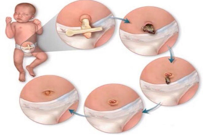 Vệ sinh rốn cho trẻ đúng cách