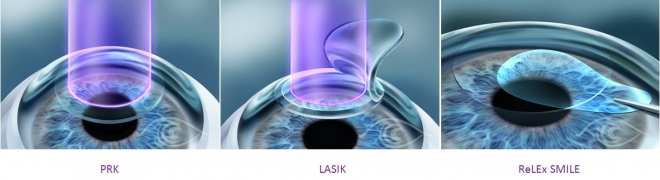 so-sanh-prk-lasik-smile
