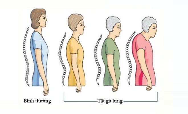 người cao tuổi gù lưng