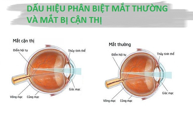 dấu hiệu mắt cận thị