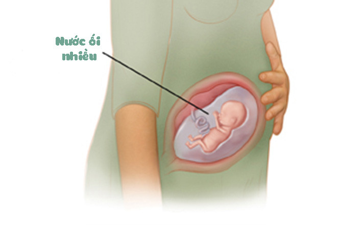 Tình trạng nước ối nhiều