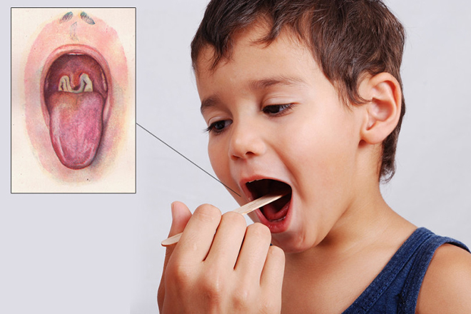 Bệnh bạch hầu ở trẻ em