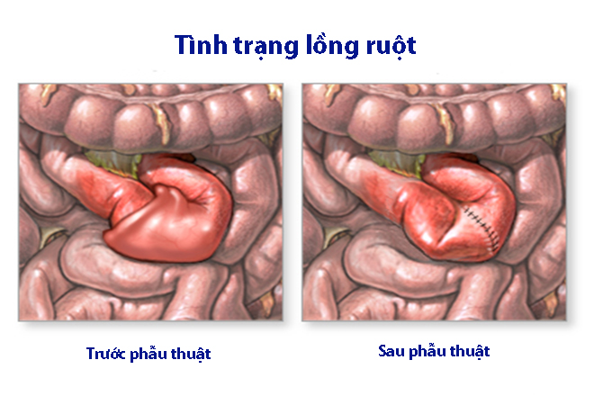 Chứng lồng ruột