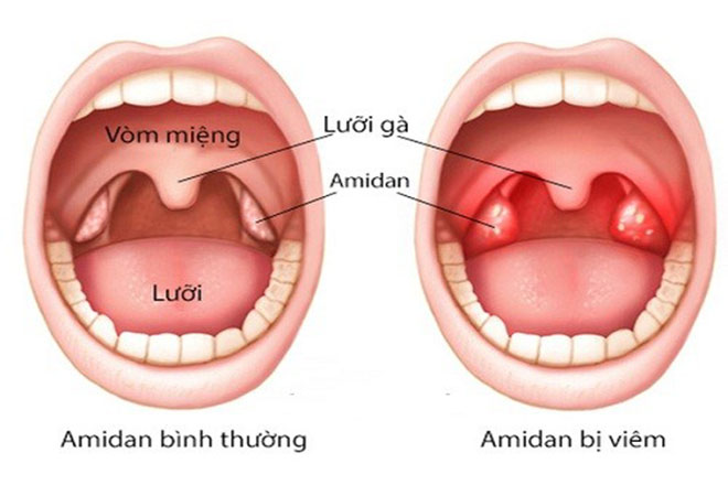 Amidan bị viêm