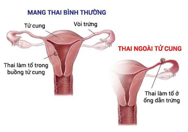 thai ngoài tử cung
