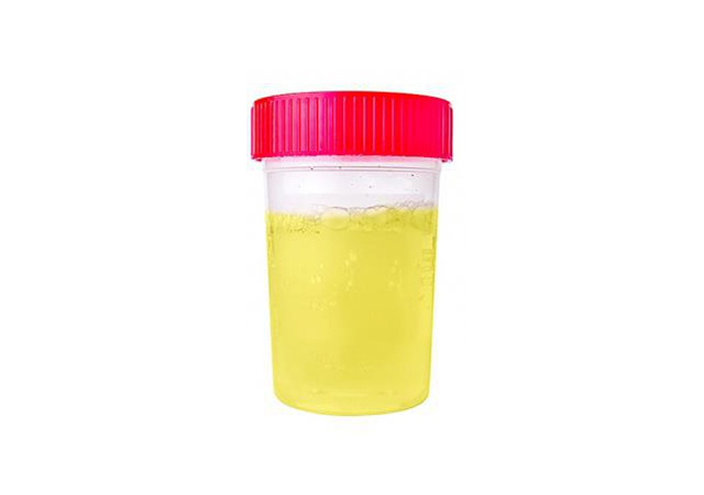 nước tiểu sáng màu