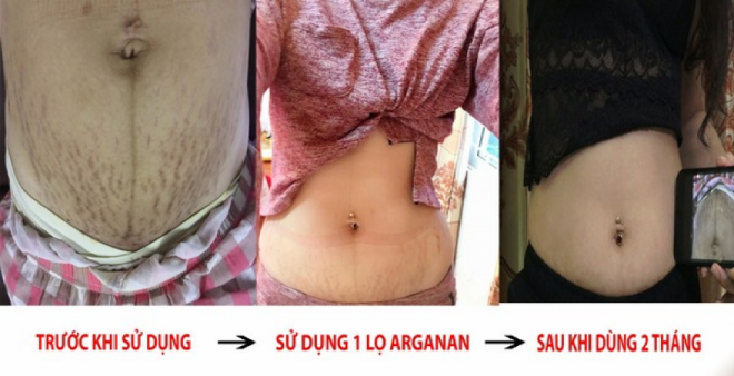 Chị Huyền sau 2 tháng sử dụng Arganan