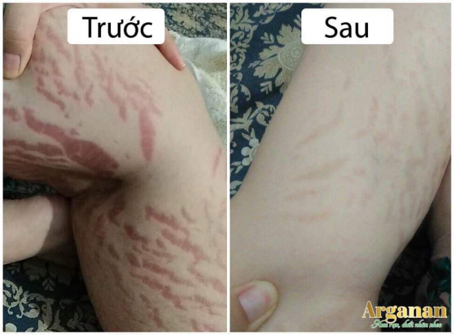 Khách hàng rạn dậy thì trước và sau khi dùng Arganan