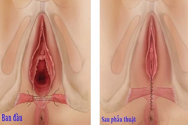 tầng sinh môn