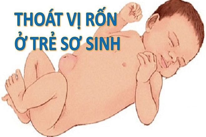 thoát vị rốn