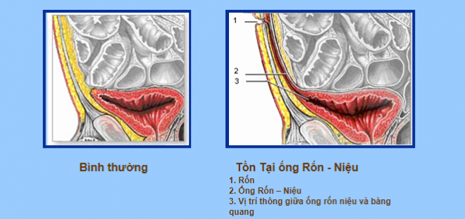 ống niệu rốn