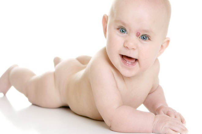 Trẻ bị bênh u máu