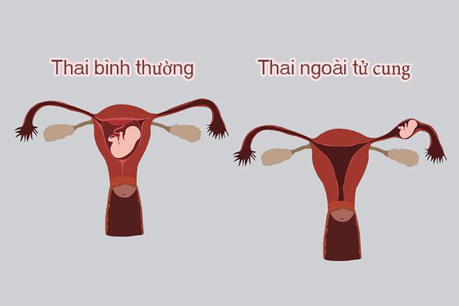 Có thai ngoài tử cung