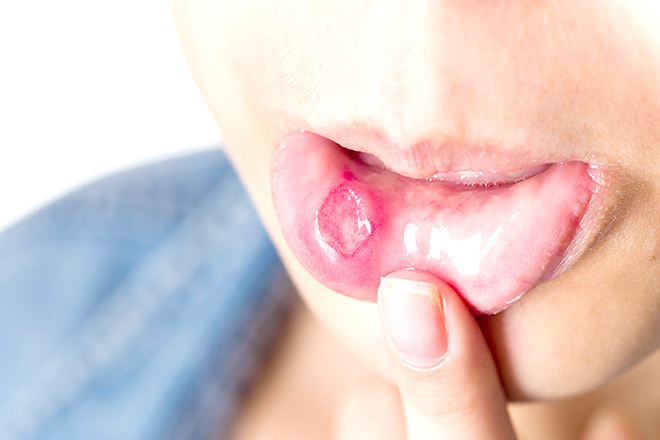 Bệnh nhiệt miệng ở trẻ em
