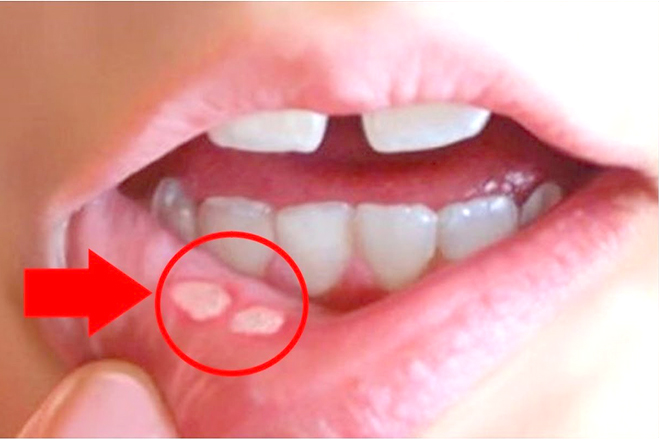 Bệnh nhiệt miệng ở trẻ