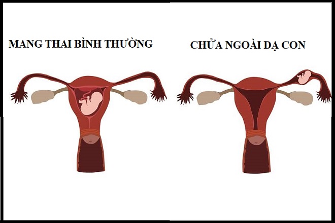 Chửa ngoài dạ con