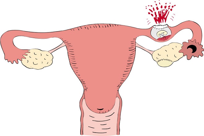 Hậu quả của việc mang thai ngoài tử cung