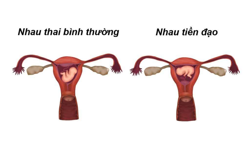 bệnh nhau tiền đạo