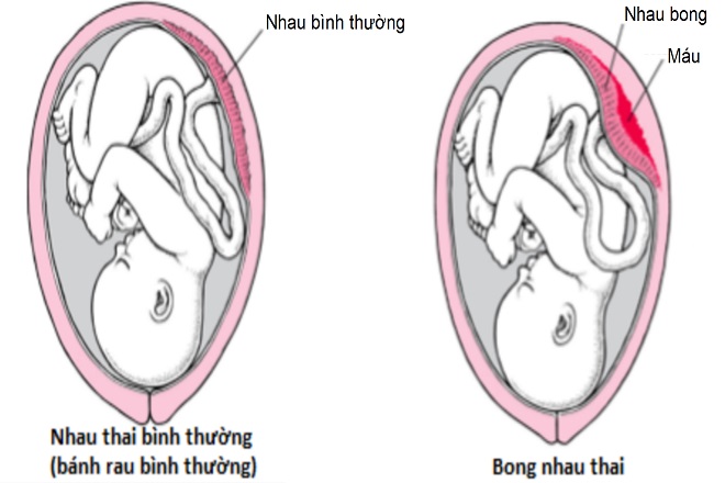 Bong nhau non