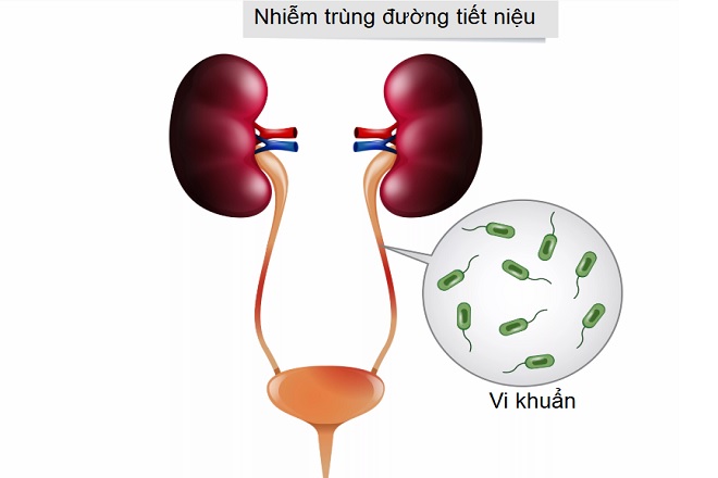 Nhiễm trùng đường tiết niệu