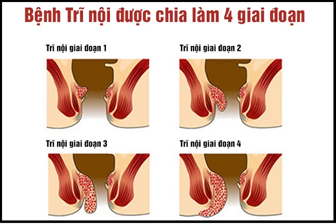 bệnh trĩ
