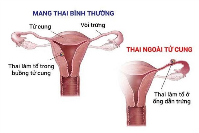 mang thai ngoài dạ con