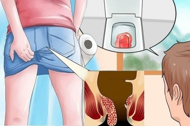 dấu hiệu bệnh trĩ