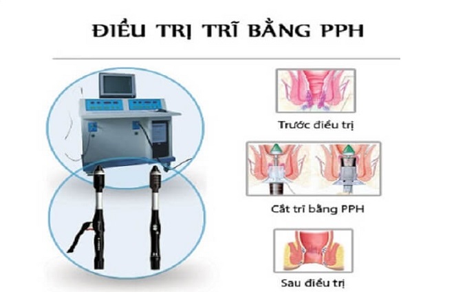 điều trị bệnh trĩ
