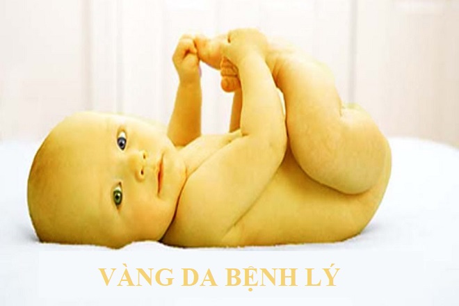 vàng da bệnh lý
