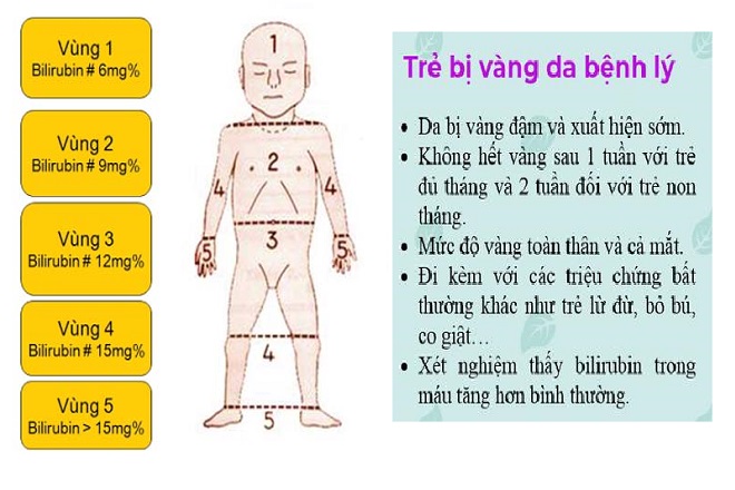 Biểu hiện vàng da bệnh lý
