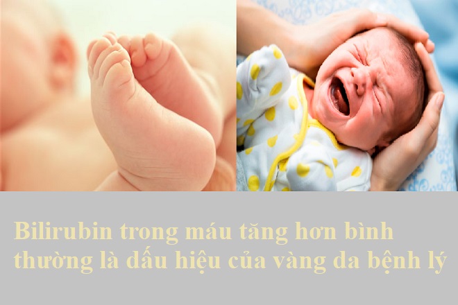 bé bị vàng da