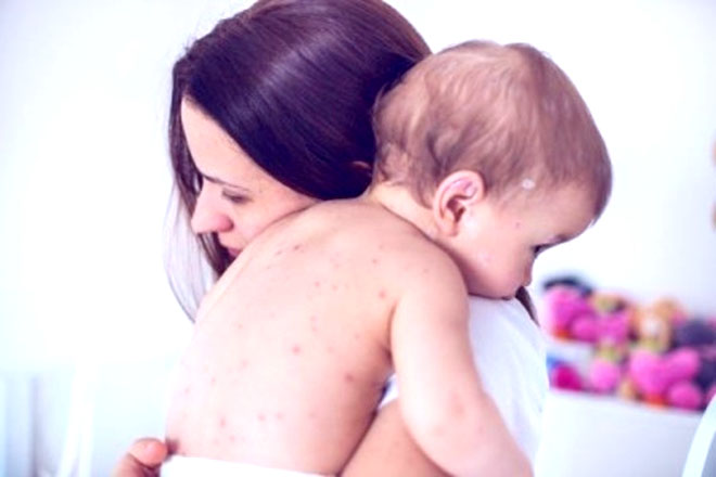 Trẻ bị sởi ăn uống kém và mệt mỏi