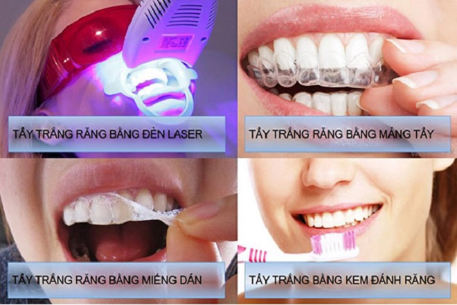 giải pháp trắng răng