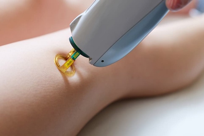 Triệt lông vĩnh viễn có an toàn không