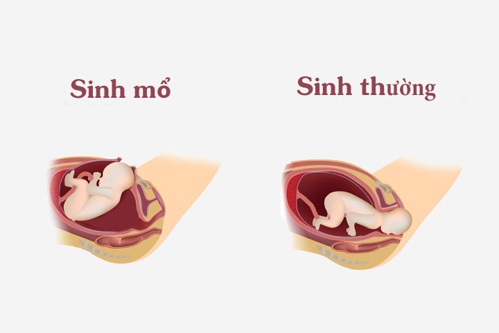 Sinh thường và sinh mổ