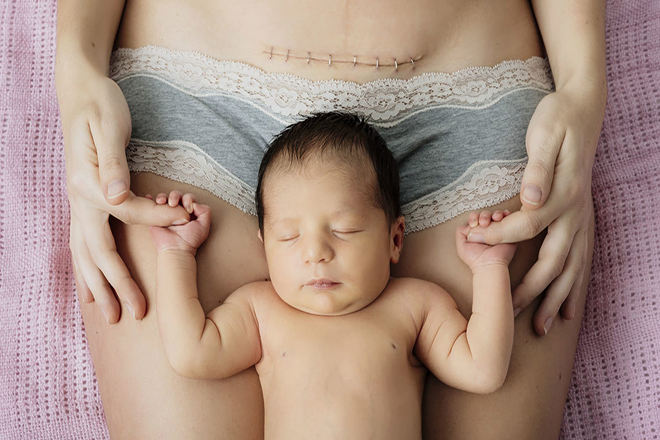 Mẹ sinh mổ lâu phục hồi hơn