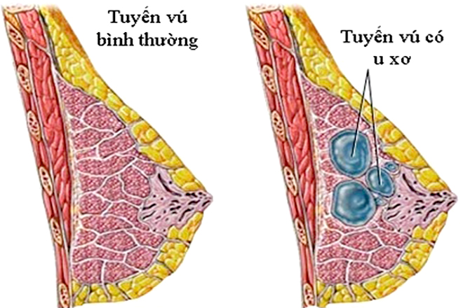 Xơ nang tuyến vú