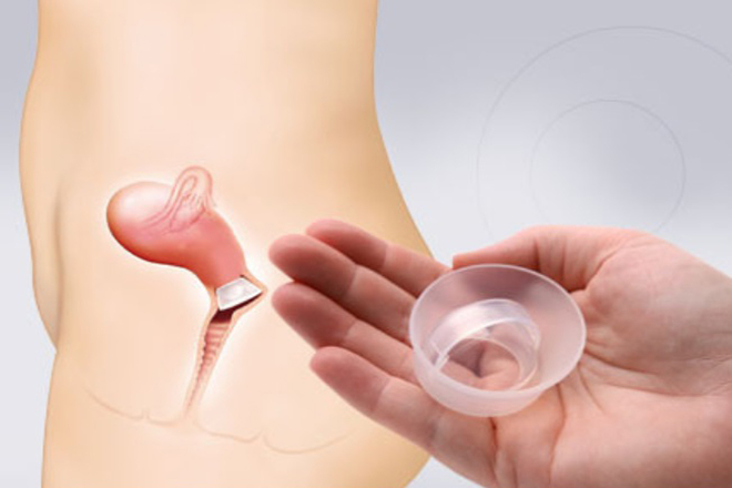 Nắp chụp cổ tử cung