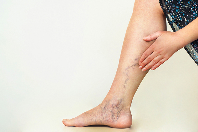 Giãn tĩnh mạch chân ở bà bầu