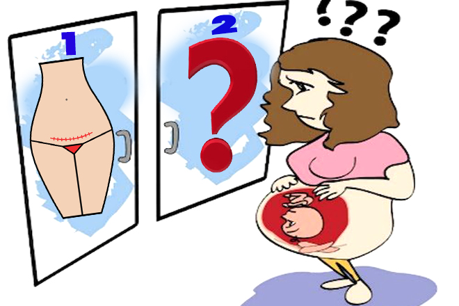 Sinh mổ được mấy lần