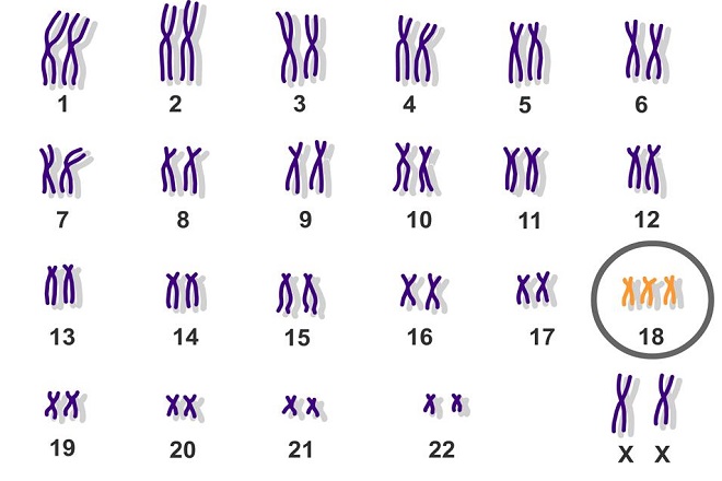 trisomy 18