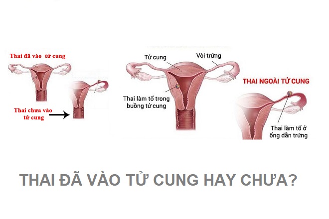 thai vào tử cung